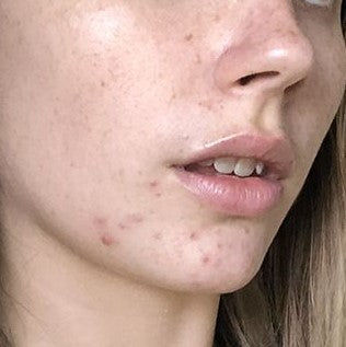 Kit A6 Acné Hormonal en piel Grasa a Mixta con Barros Enterrados en Zona U